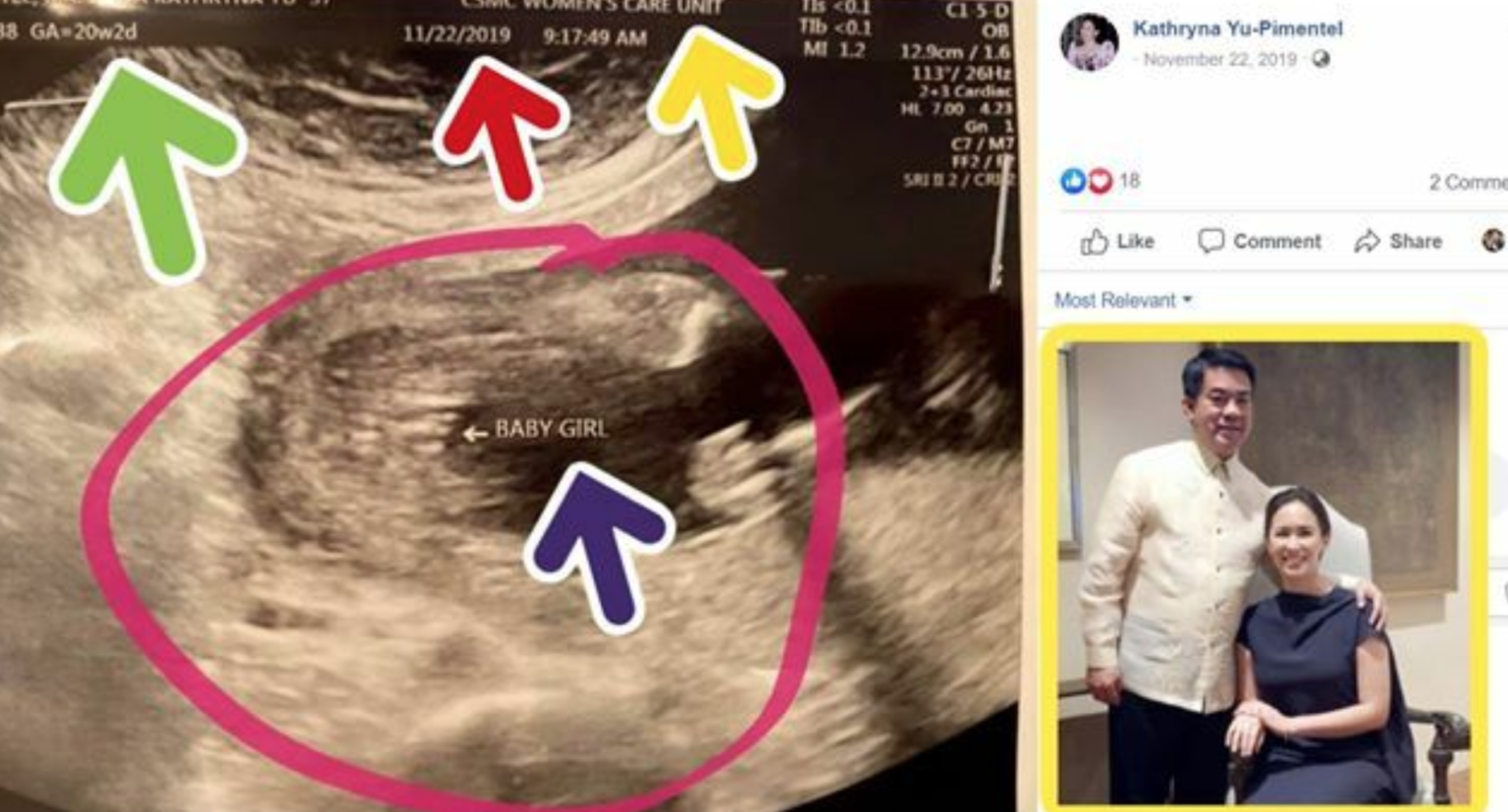 Koko Pimentel S Wife Kathryna Yu Pimentel Gave Birth To A Baby Girl